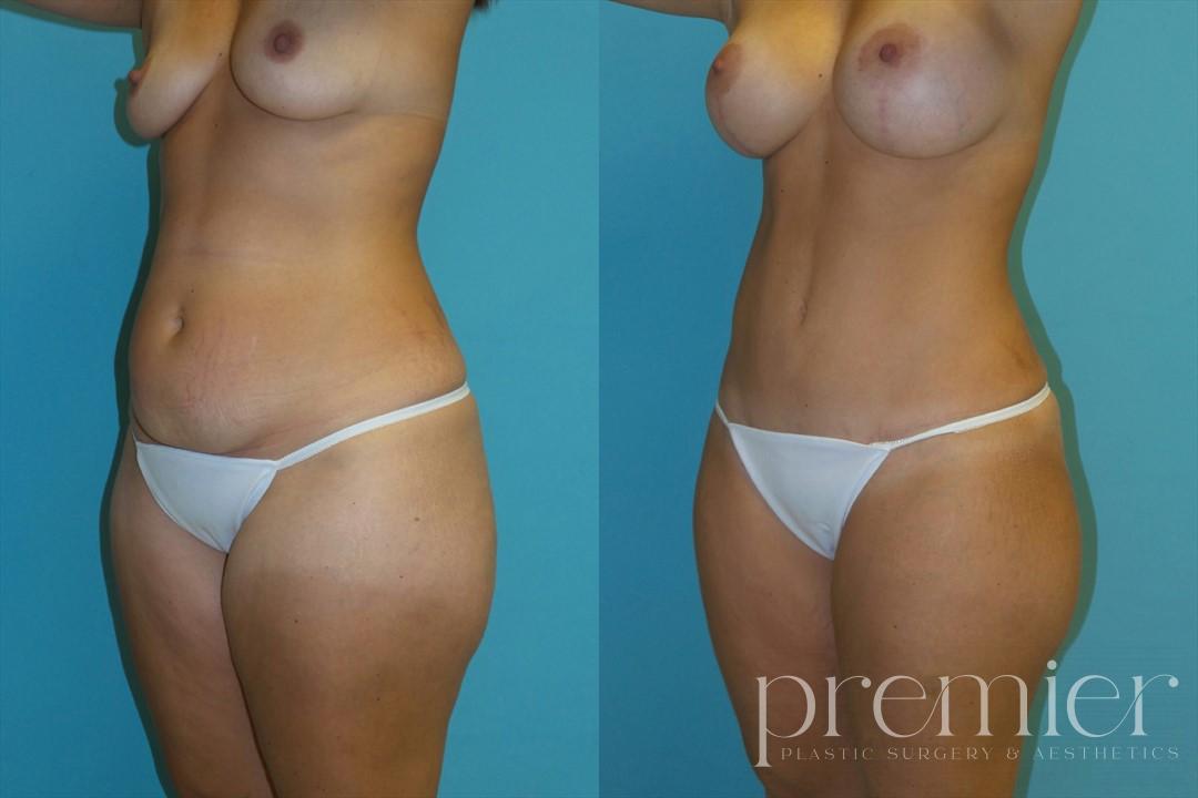 Before and After Image: Tummy Tuck - 