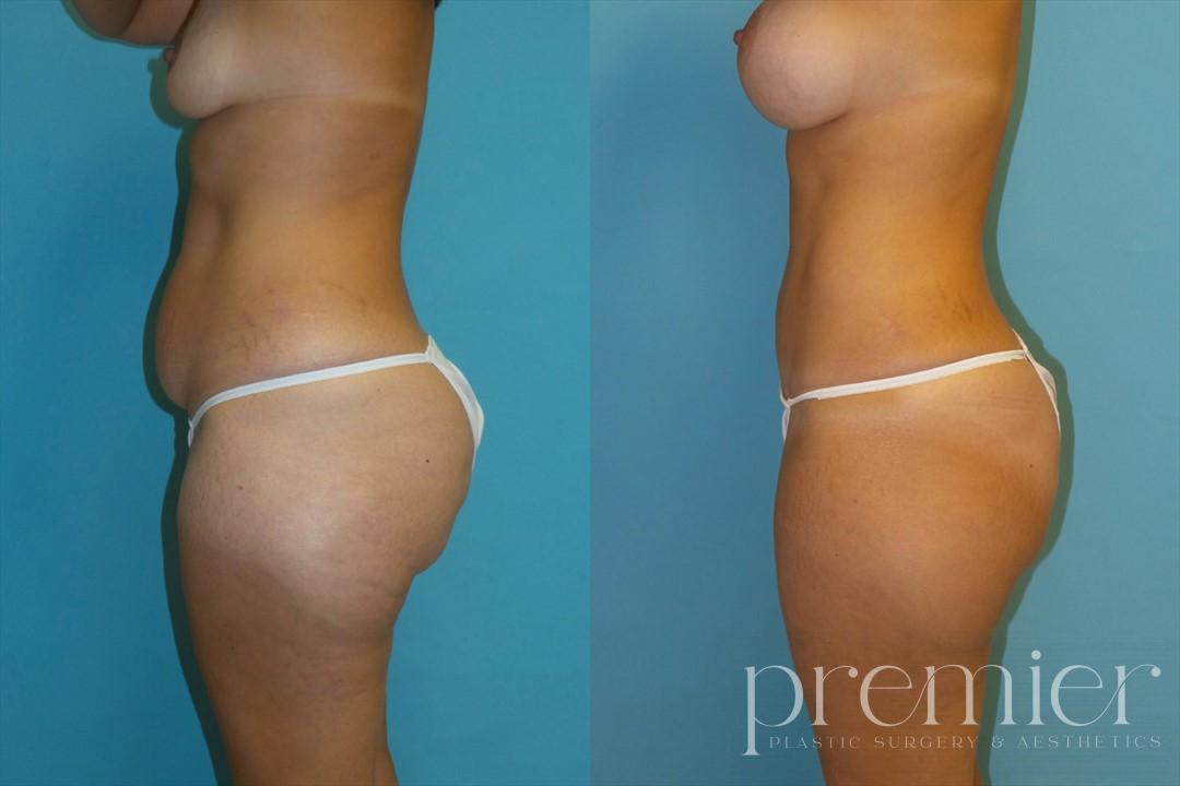 Before and After Image: Tummy Tuck - 