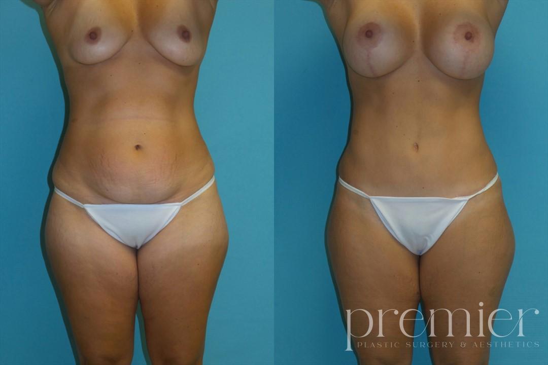 Before and After Image: Tummy Tuck - front