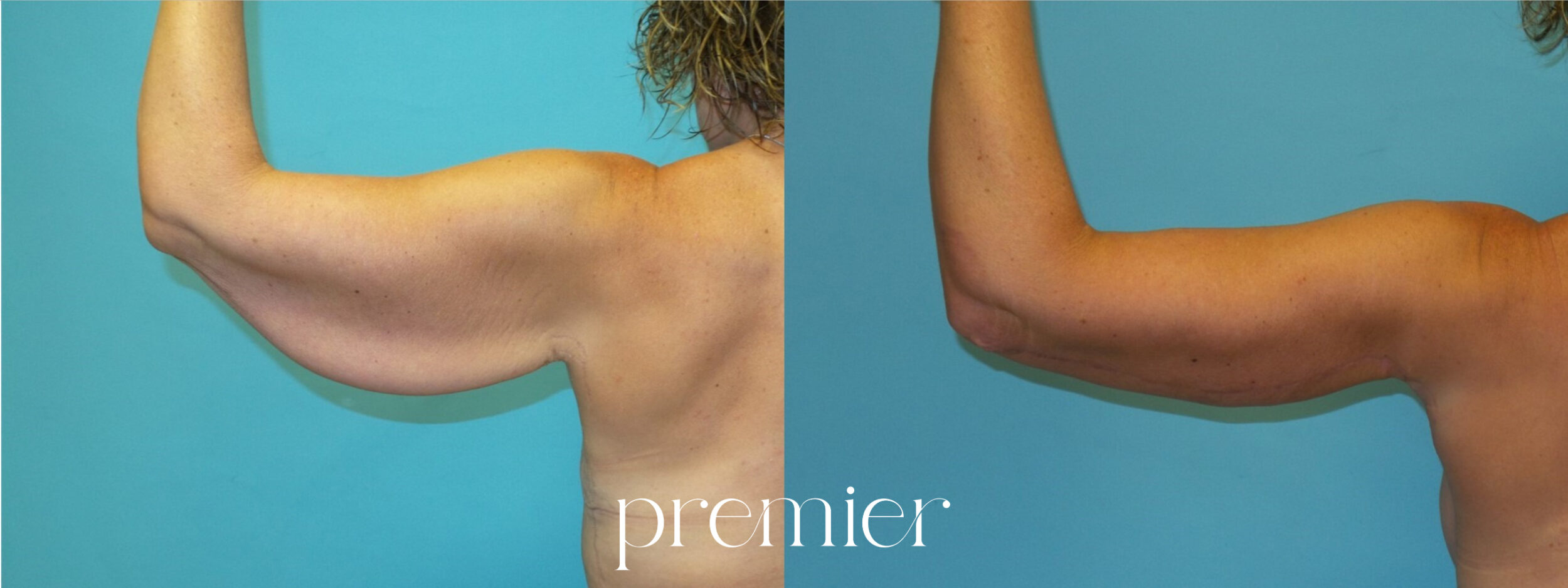 Before and After Image: Arm Lift - back