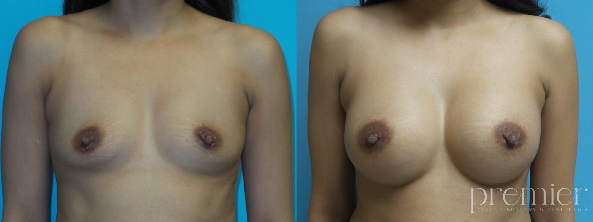Before and After Image: Breast Augmentation - front