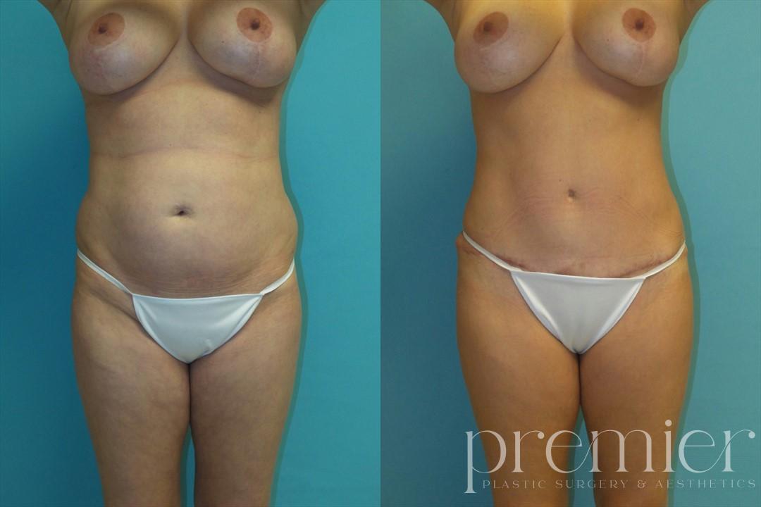 Before and After Image: Tummy Tuck - front