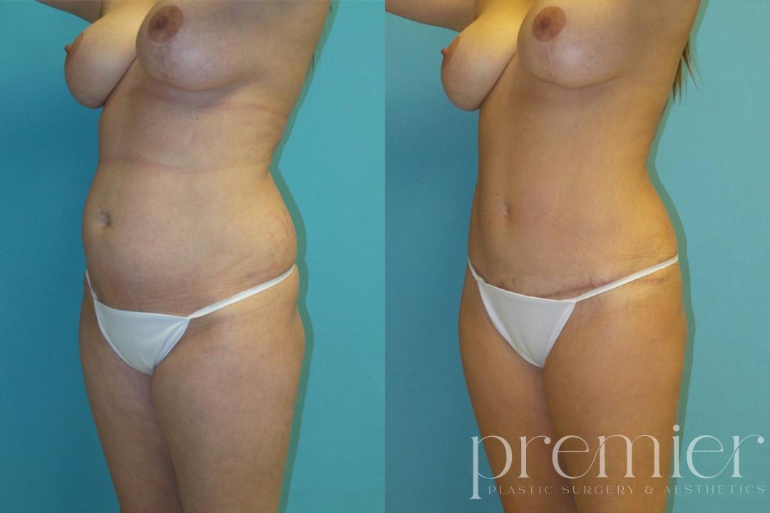 Before and After Image: Tummy Tuck - left-front-oblique