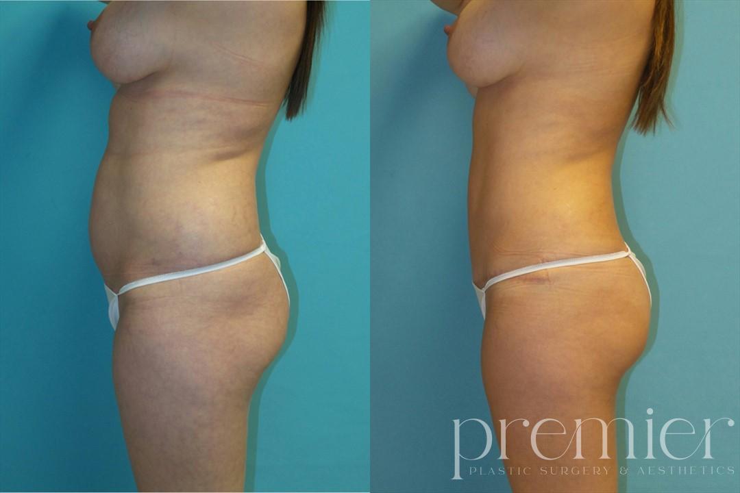 Before and After Image: Tummy Tuck - left-side